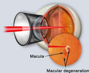 macular 5.jpg